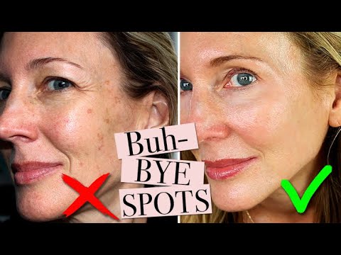 How To Get Rid of Age Spots!