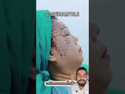ESTIRAMIENTO DE ROSTRO #redhemostatica
