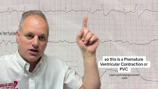 Ekg Ysis Of Pvcs Premature Ventricular Contractions