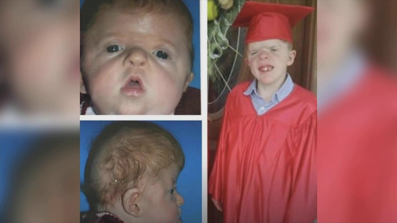 World-renowned craniofacial surgeon performs surgery at Erlanger