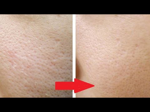 РАСШИРЕННЫЕ ПОРЫ - как избавиться? Чем сузить поры на лице? Что помогает от расширенных пор?