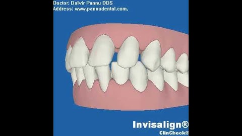 VM Clincheck Invisalign Left View