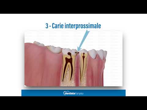 Video: Cavità Interprossimale: Una Cavità Tra I Denti