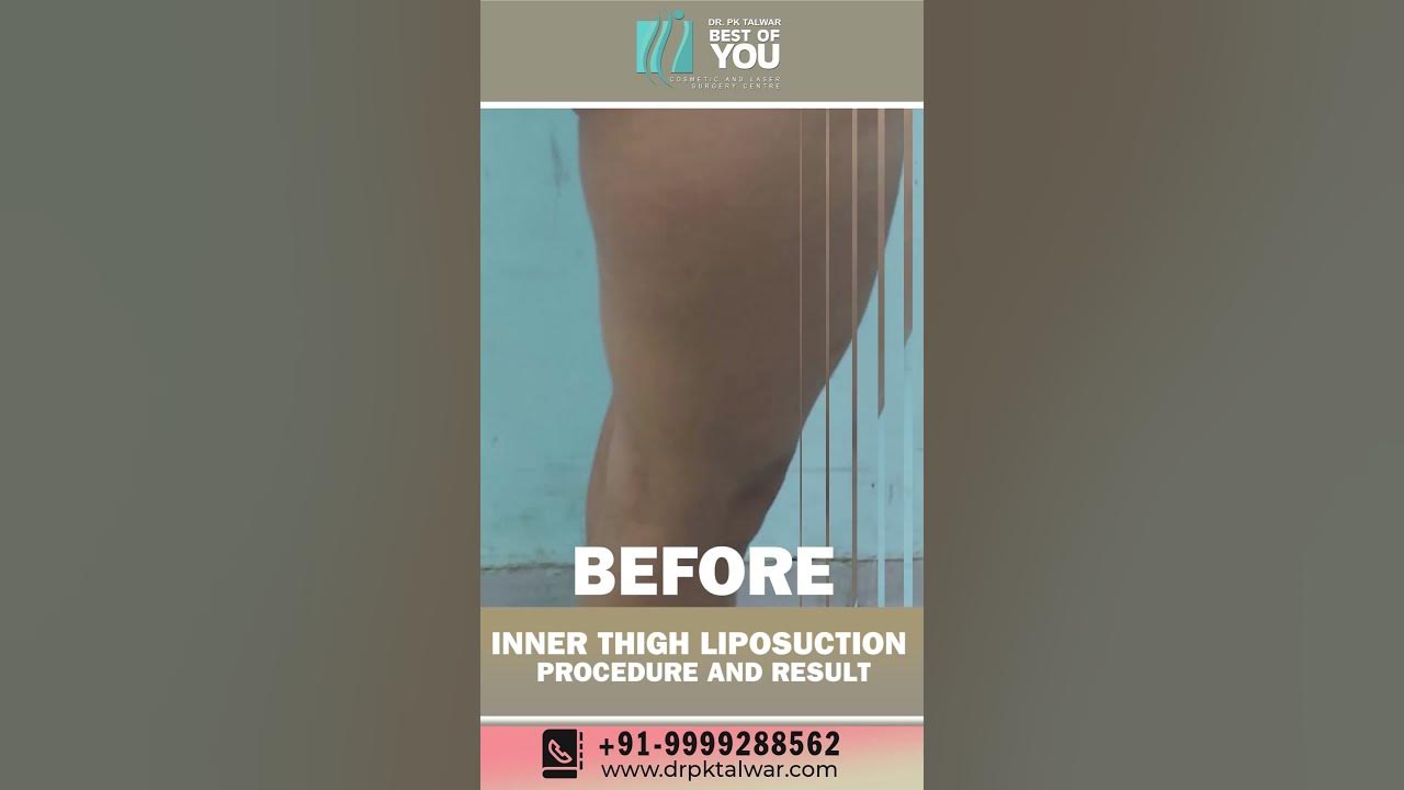Inner Thigh Liposuction Procedure and Its Results BeforeAfter Results of Thigh Liposuction