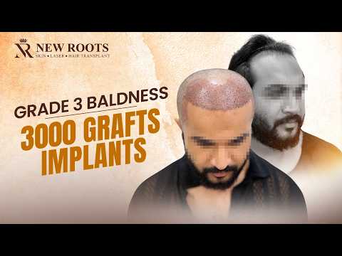 3000 Grafts Done… RESULTS LOADING! ⏳ | Grade 3 Baldness | Hair Transplant in Pune | New Roots