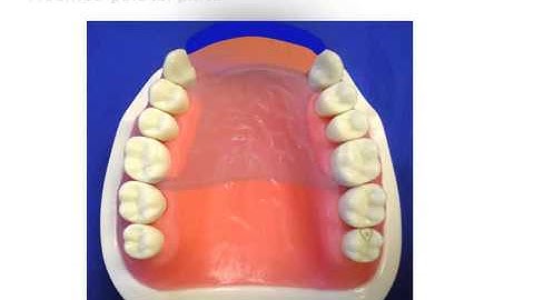 Kennedy Class IV Design