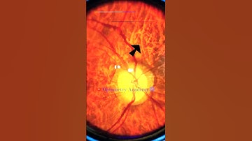 High Myopic Fundus | Fundus Photography | Myopic Crescent | Short Video 301 #viral #optometryacademy