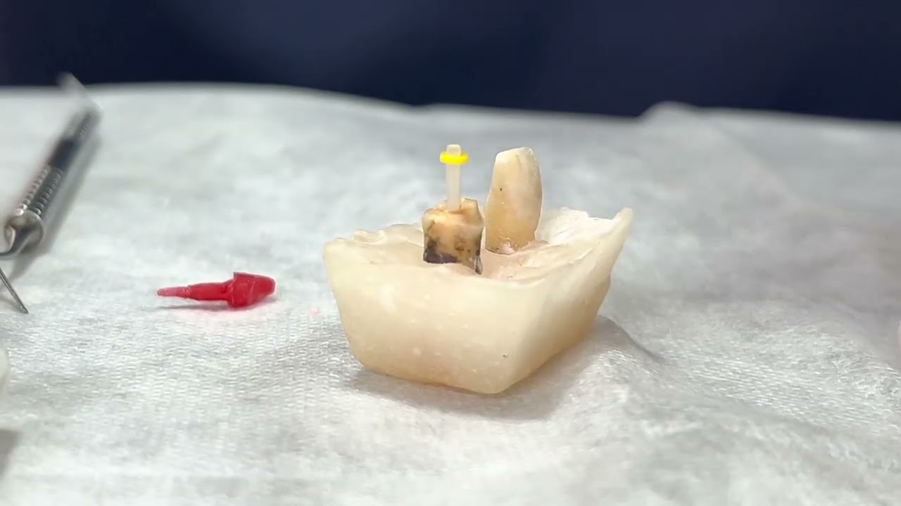 Reconstrução coronária. Núcleo pré fabricado de FIBRA DE VIDRO, Parte I.