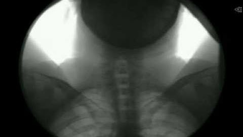 Man Swallows Surgical Forceps Moving X-ray Fluoroscope