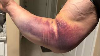 Crazy Biceps Injury
