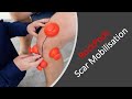 Scar massage for knee scars with rockpod dry cupping therapy