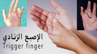 علاج الاصبع القافزة - اكتشف الحل الفعّال للألم/Trigger finger treatment