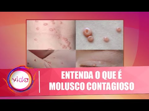 Vídeo: Quem pode pegar molusco contagioso?