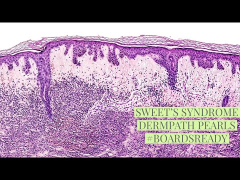 Sweet’s disease, explained by a dermatopathologist.  Unk #16.