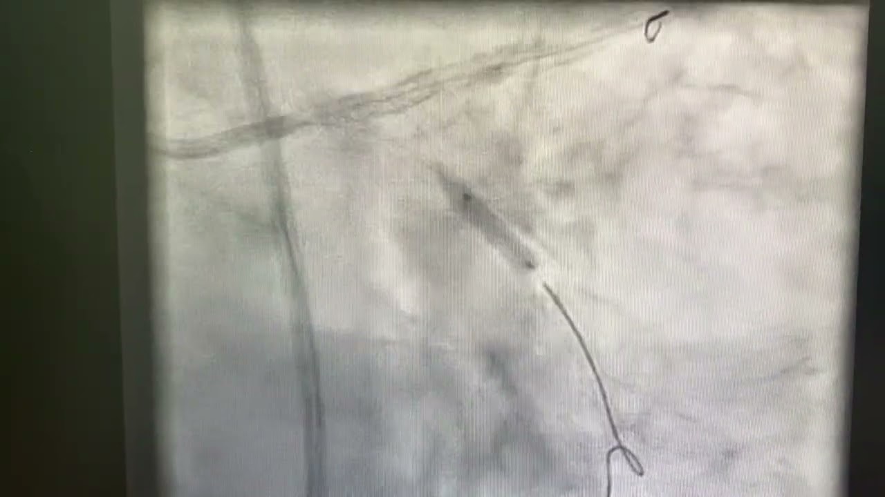 Left main coronary Intervention