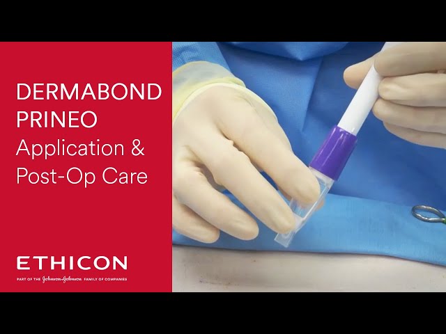 Step-by-Step Guide for Effective Application of DERMABOND PRINEO Skin  Closure System