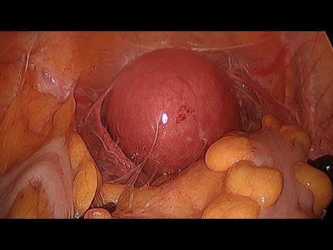 Complex Hysterectomy Surgery Made Easy On Woman With Fibroids And Adhesions