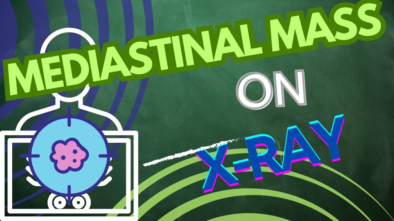 Mediastinal mass on X-ray made simple #radiology #radiologystudent #chestxray #medicine