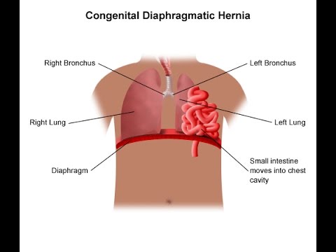 Video: Huwag Pansinin Ang Posibilidad Ng Isang Diaphragmatic Hernia