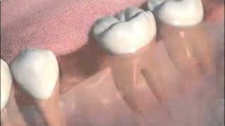 Bridges at Cathedral Dental Clinic
