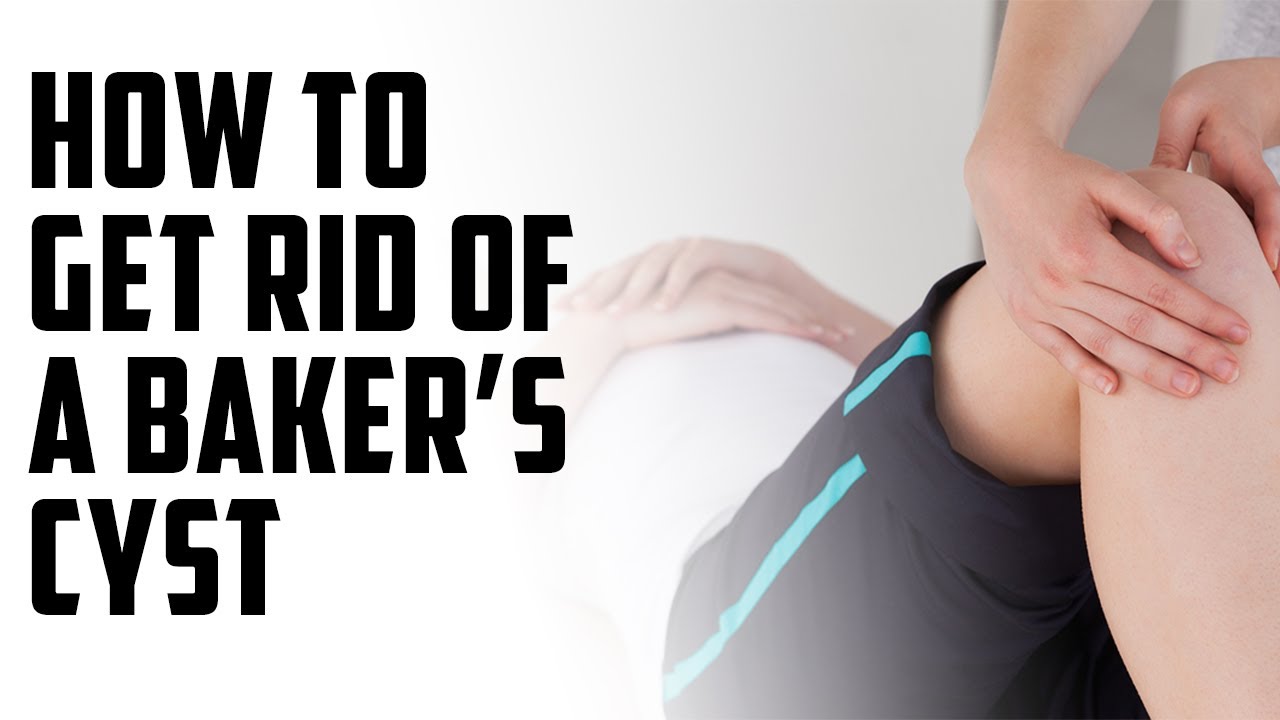 how do you get rid of a baker's cyst A Episode 65 YouTube
