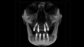 All-on-4 bimaxilar la pacient cu dentitie terminala (boala parodontala grava)