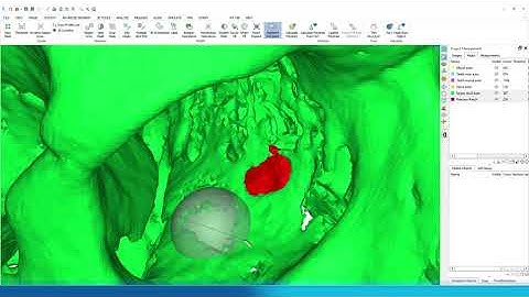 Segment Thin Bones Faster | Mimics Innovation Suite 24