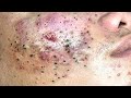 Blackhead Removal With Sac Dep Spa @10006890