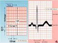 EKG: INICIO DE LECTURA