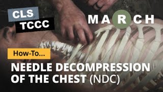 Tccc - Needle Decompression Of The Chest
