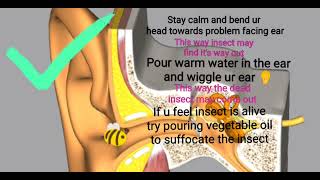 What To Do When A Bug Enters Your Earsave Your Earbug In Ear