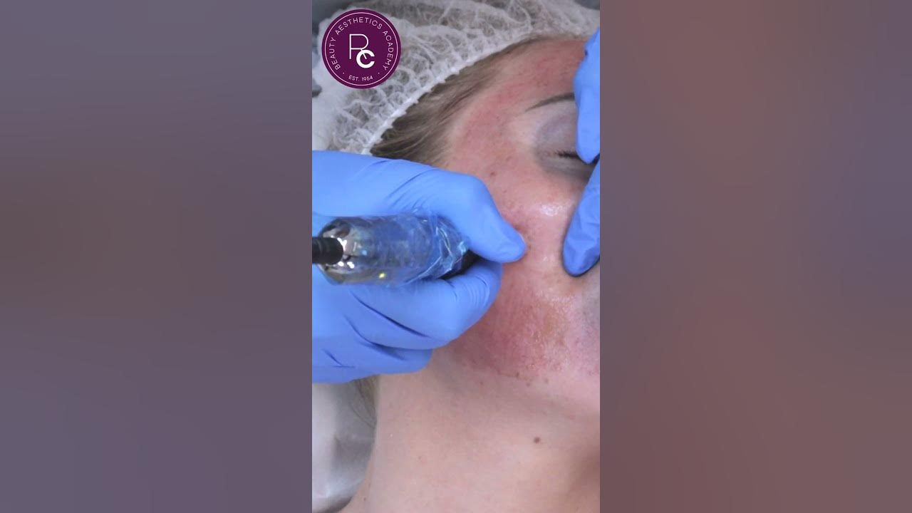 7 Step Skin Needling Treatment Step By Step Procedure Performance
