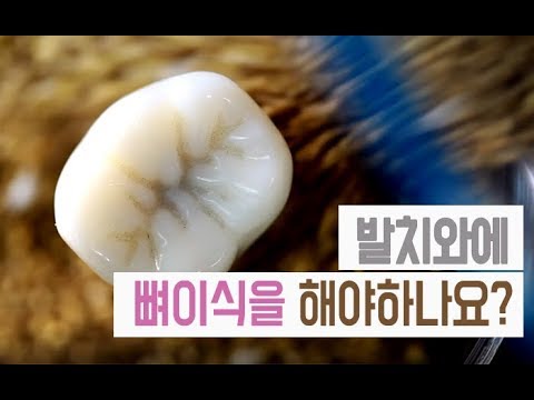 임플란트 가격
