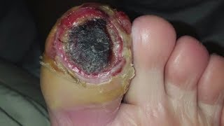 Diabetic Toe - Dr. ER
