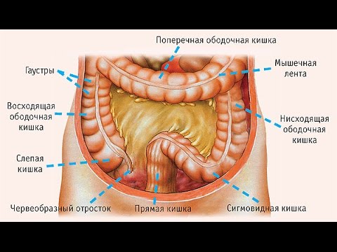 Сигмовидная кишка. Нормальная и пораженная раком