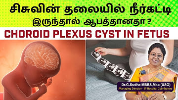 Is it dangerous to have a hydrocele in the head of a fetus? Choroid Plexus Cyst in Fetus : Dr. G....
