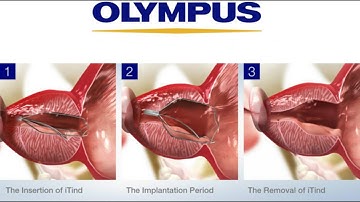 iTind for BPH Education Video