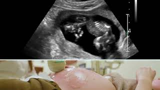 Weird Looking fetus (yet normal ) @14 weeks  | Ultrasound Case