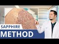 What Is The Sapphire Hair Transplant? | Dr. Balwi Explains