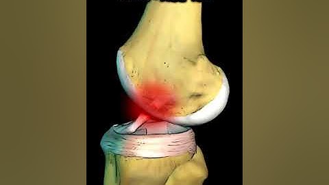 Pivot Shift Test of the Knee , ACL TEAR #shorts