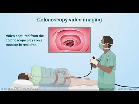 Video: Sigmoidoskopija - Indikacije, Komplikacije, Priprema