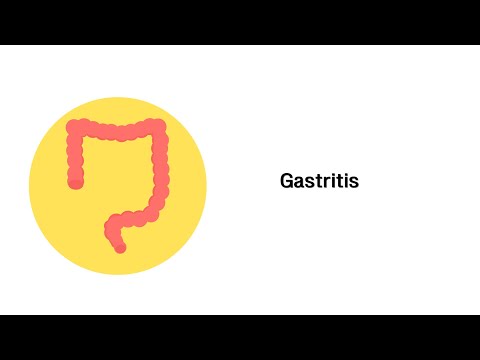 Video: Unterschied Zwischen Akuter Und Chronischer Gastritis