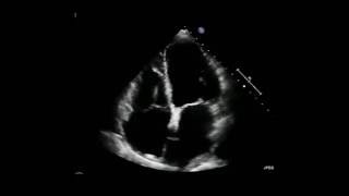 2D Tte Schlechte Pumpfunktion