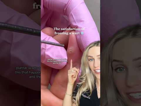 Doctor reacts: how to treat warts