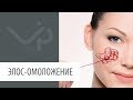 Элос-омоложение (удаление сосудов на лице): преображение пациента