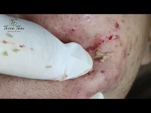 Big Cheek Acne - Blackheads & Acne Treatment Hottest Videos #059 #443