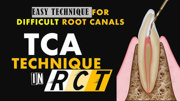 TCA TECHNIQUE | COMPLICATED ROOT CANAL TREATMENT MADE EASY