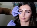 Under Eye Fillers For Dark Circles
