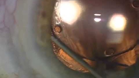 Managing A Dislocated Sulcus IOL