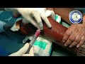Traumatic Haemarthrosis knee | Haemarthrosis Aspiration | Big bore needle Aspiration knee | Adamya H